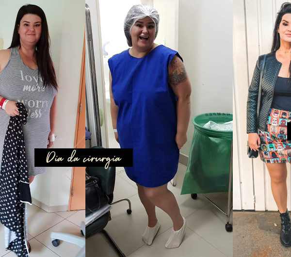 Cirurgia bariátrica: por que optei por ela! Conheça mais sobre minha história e veja meu antes e durante