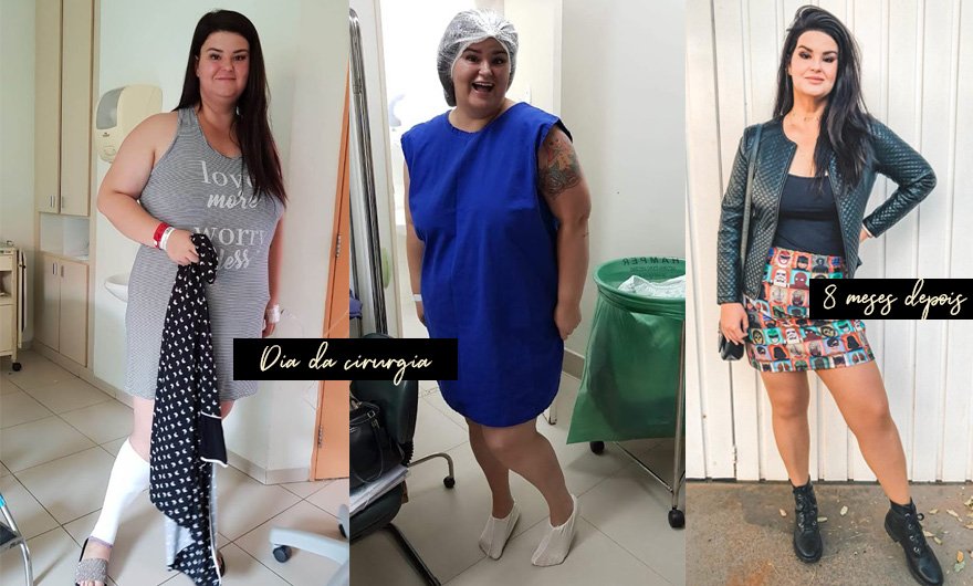 Cirurgia bariátrica: por que optei por ela! Conheça mais sobre minha história e veja meu antes e durante